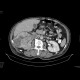 Renal cell carcinoma, renal vein thrombosis, thrombosis of the inferior vena cava: CT - Computed tomography